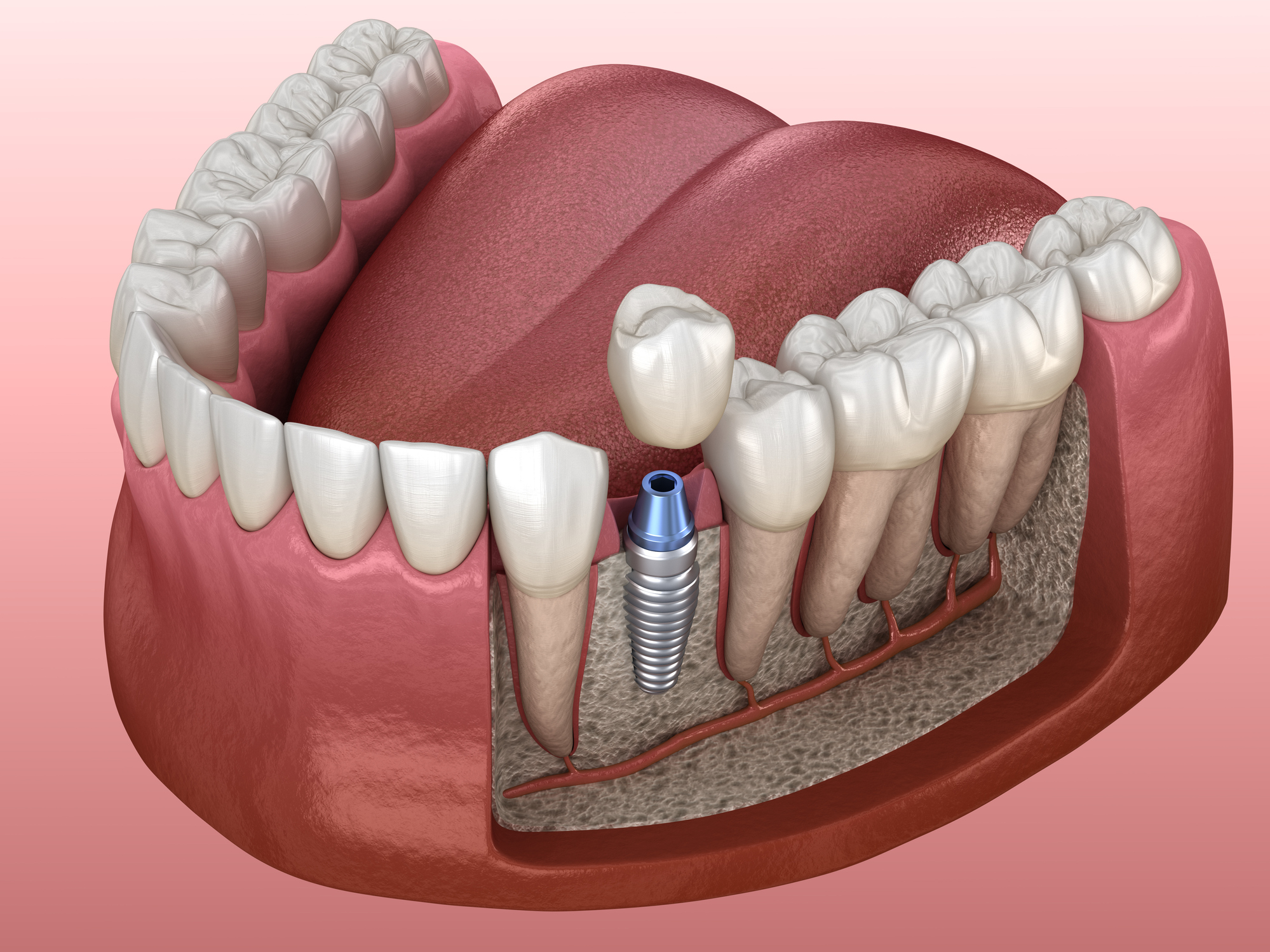 medical tourism dental implants surgery